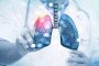 Médecine: Un nouvel outil pour combattre la récidive du cancer du poumon